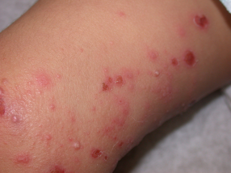 Karsil de que ayuda a la psoriasis